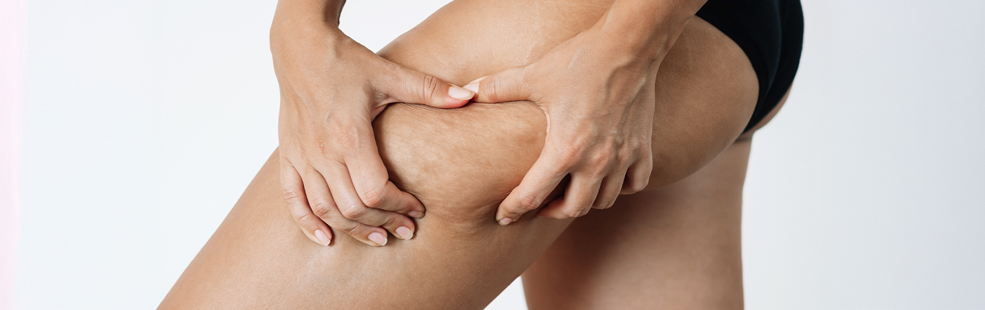 Selülit Neden Oluşur?